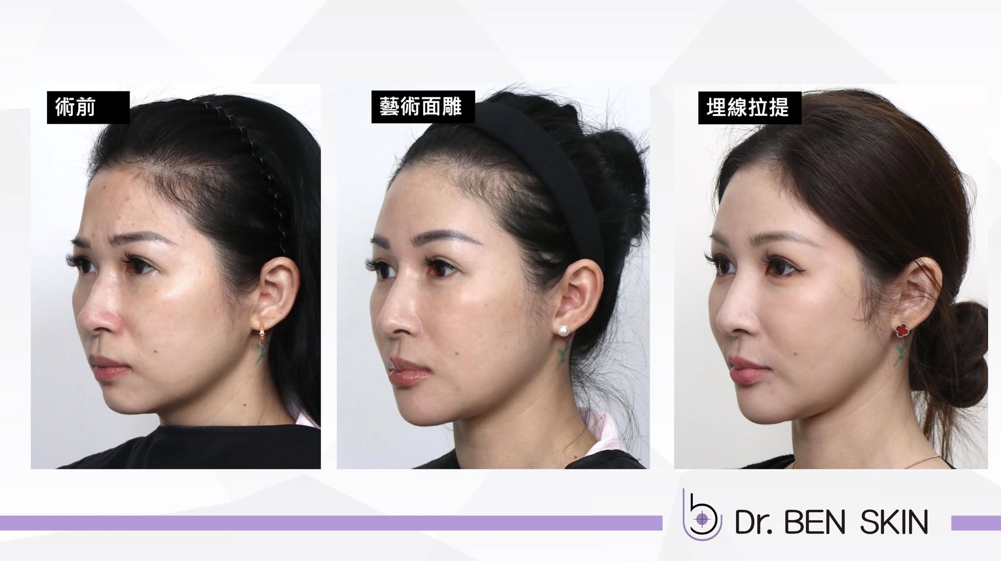 藝術面雕到埋線拉提三階段側面比較